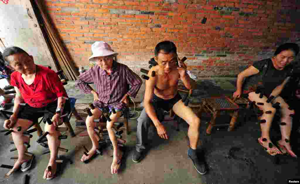 People receive the local traditional cupping treatment at a clinic in Pujiang county, Chengdu, China, Aug. 10, 2016.