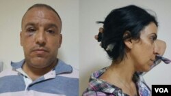 Wartawan yang bekerja untuk VOA, Mahmut Bozarslan (kiri) dan Hatice Kamer mengalami luka-luka setelah serangan di Midyat, Turki, Rabu (8/6).