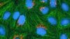 Laser Brain Cancer Treatment May Offer Extra Advantage
