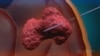 Doctors Unveil Potential New Tool to Fight Brain Cancer