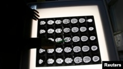 FILE - A radiologist examines the brain X-rays of a patient. In a small study, patients with brain tumors were given genetically modified poliovirus, which helped their bodies attack the cancer.