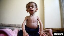 Two-and-a-half year old Hala al-Nufi, who suffers from a metabolic disorder which is worsening due to the siege and food shortages in the eastern Ghouta, reacts as she sits on a bed in the Saqba area, in the eastern Damascus suburb of Ghouta, Syria.
