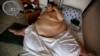 Study: Extreme Obesity Cuts 14 Years Off Life 