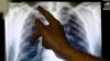 WHO: 5,000 Deaths from TB in North Korea Last Year