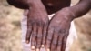 WHO Monkeypox