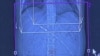 CT Scan Radiation Draws Concern