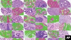 This image shows breast cancer images adjacent to matching images that have been automatically labeled by image processing software.