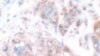 Iron-Regulating Protein Could Help Battle Breast Cancer