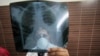 North Korea Launches First National TB Survey 