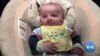 Nine In 10 Babies Born With A Cleft Condition Could Die Without Corrective Surgery 
